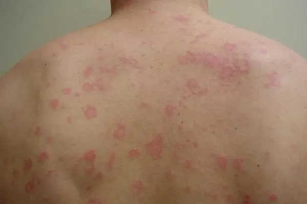 Con đường lây nhiễm bệnh giang mai