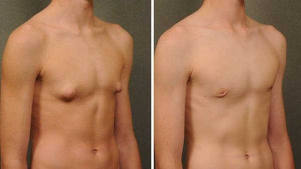 người thiếu hụt testosterone trông như thế nào