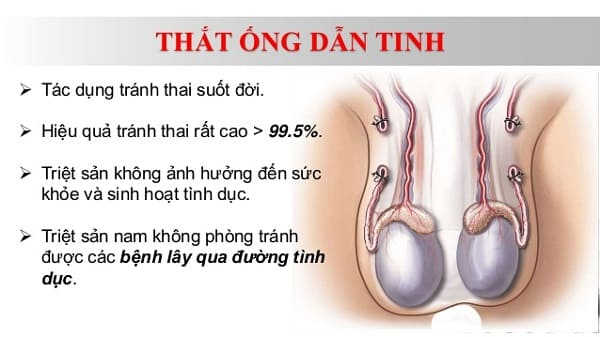 thủ thuật thắt ống dẫn tinh