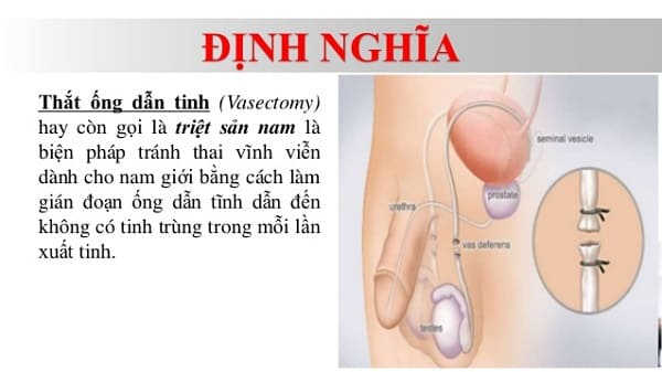 thắt ống dẫn tinh là gì