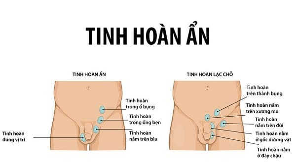 Tinh hoàn ẩn là gì