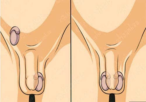 Tinh hoàn ẩn ở nam giới trưởng thành