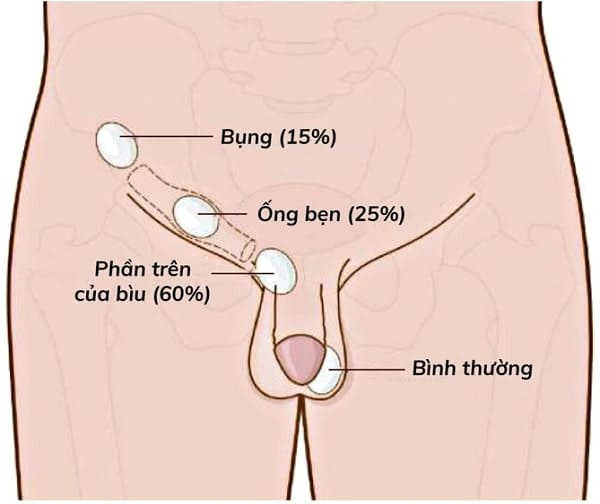 tinh hoàn ẩn trẻ sơ sinh