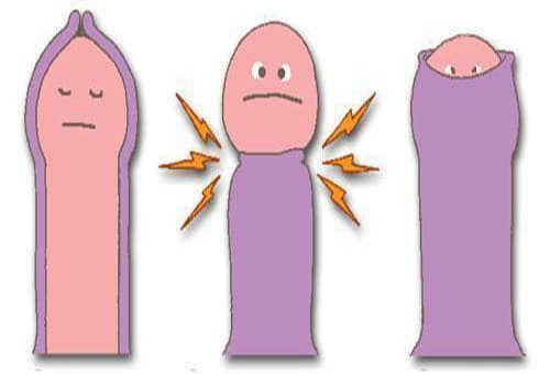 Các bệnh bao quy đầu thường gặp 2