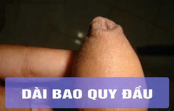 Các bệnh bao quy đầu thường gặp 3