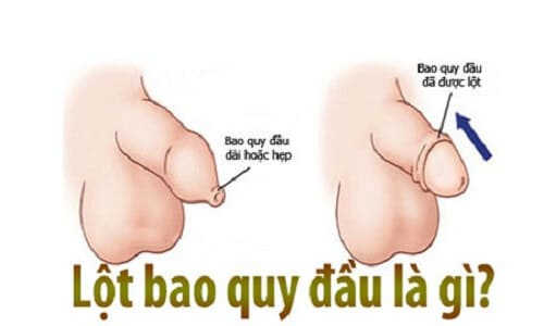 lột bao quy đầu cho trẻ thế nào