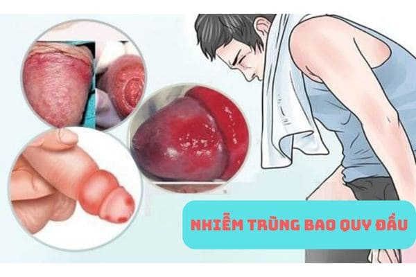 nhiễm trùng bao quy đầu bệnh lý nguy hiểm