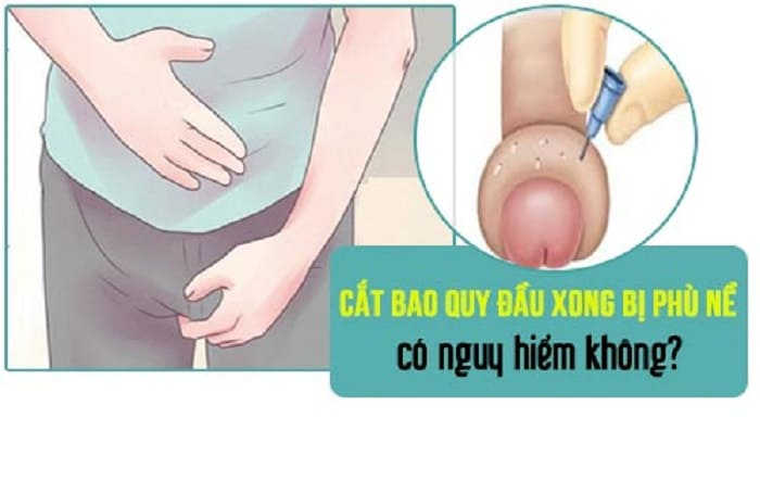Sau khi cắt bao quy đầu bị bầm tím phù nề là sao