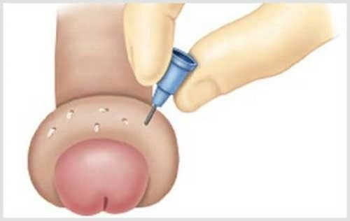 Sau khi cắt bao quy đầu bị bầm tím phù nề là sao 2