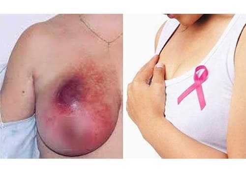ung thư vú triệu chứng dấu hiệu và giải pháp điều trị