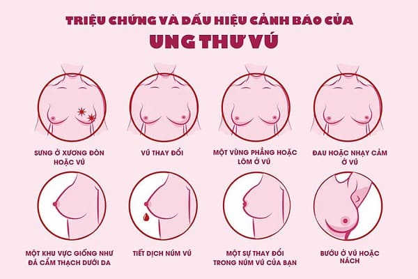 dấu hiệu ung thư vú