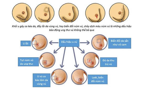 phát hiện sớm dấu hiệu ung thư vú
