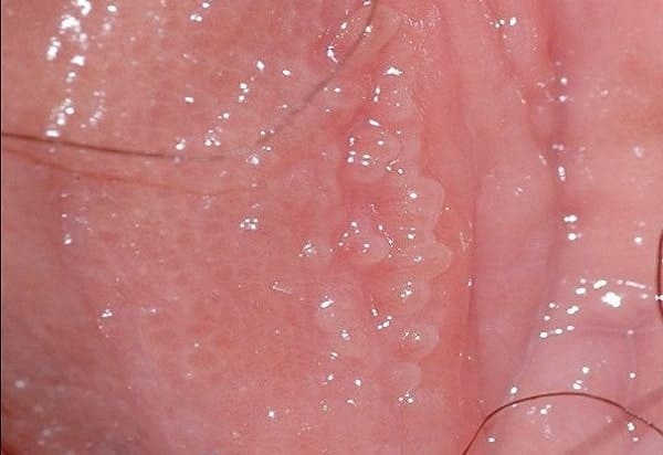 gai sinh dục nữ là gì