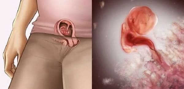 hình ảnh phá thai 5 tuần tuổi 3