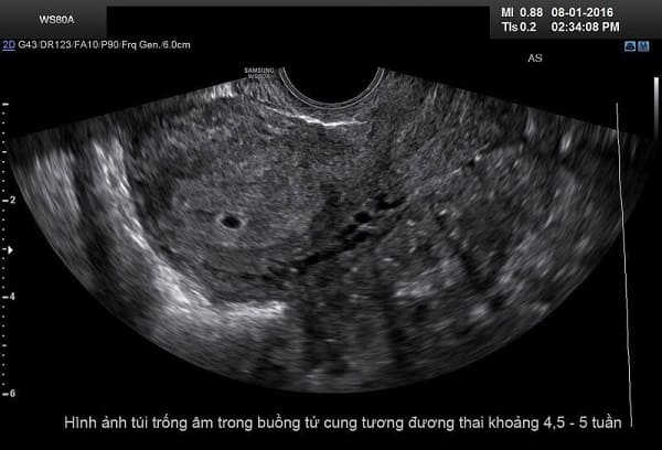 hình ảnh phá thai 5 tuần tuổi 2