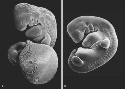 hình ảnh phá thai 5 tuần tuổi