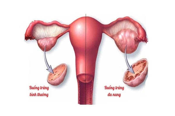 bệnh phụ khoa buồng trứng đa nang