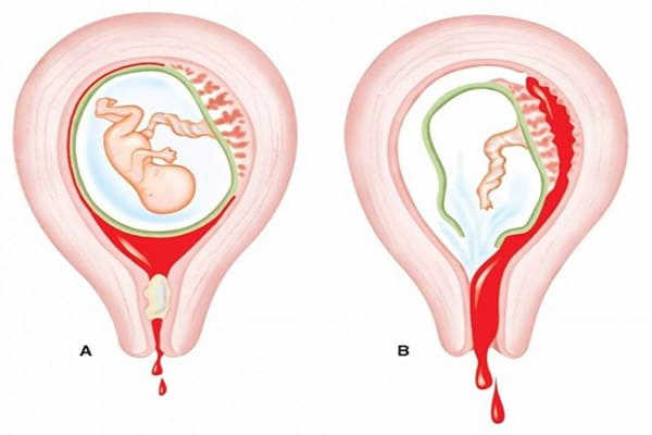 phá thai bị sót thai