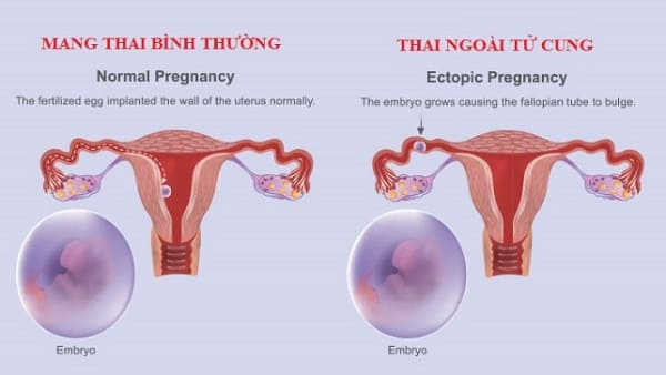 điều kiện để phá thai bằng thuốc