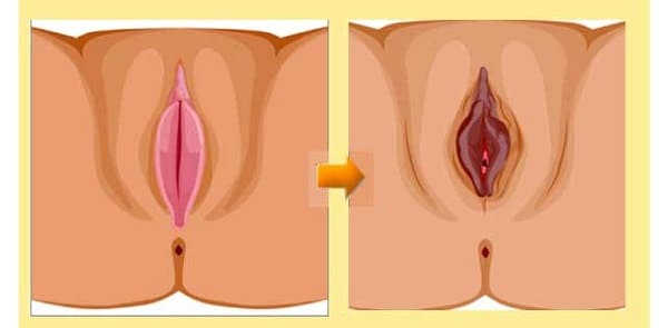 vùng kín thâm đen