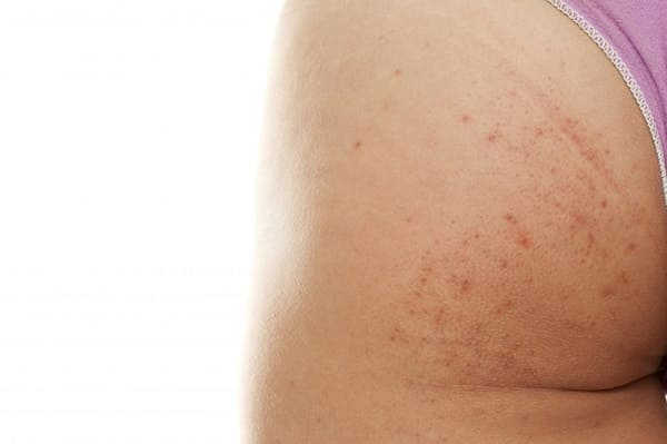 cách xóa thâm vùng kín nhanh