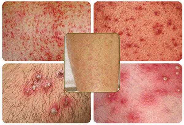 tại sao bị viêm nang lông