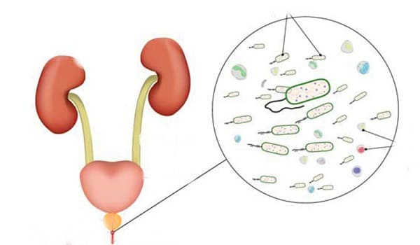 điều trị viêm niệu đạo ở nữ giới 2