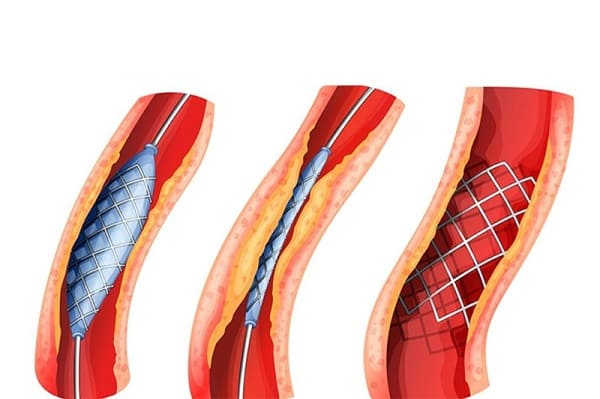 hẹp niệu đạo ở nữ giới 2