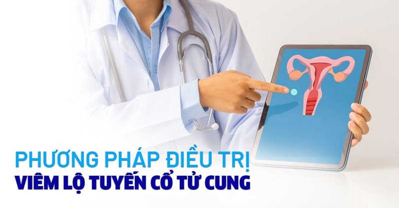 điều trị viêm lộ tuyến cổ tử cung độ 3 bao nhiêu tiền