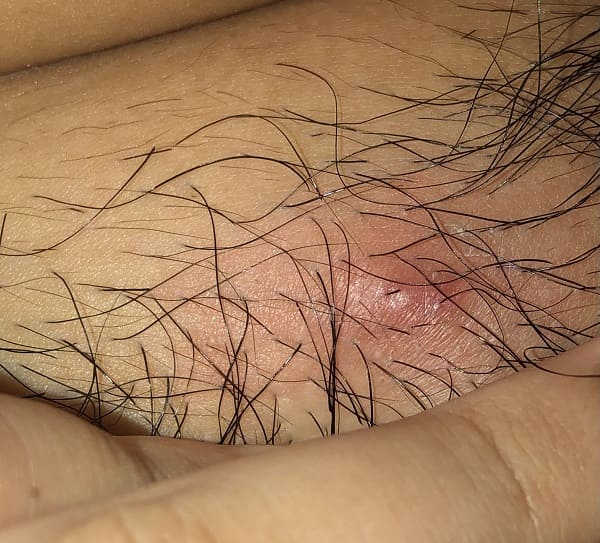 nổi mụn cứng ở vùng kín nữ giới