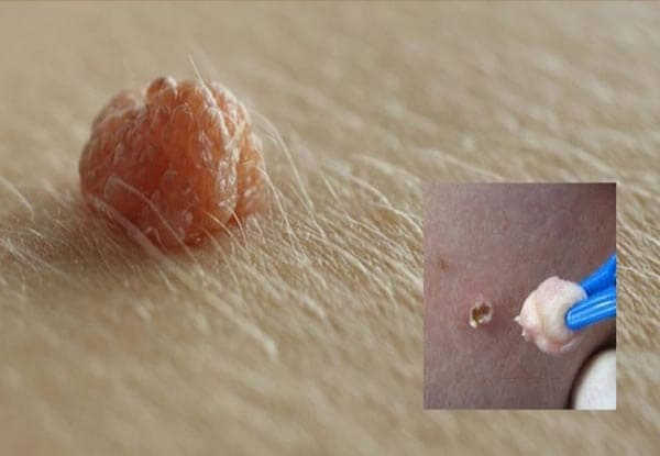 nổi mụn cứng ở vùng kín nữ giới 3