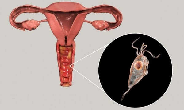 viêm âm đạo do tạp khuẩn là gì