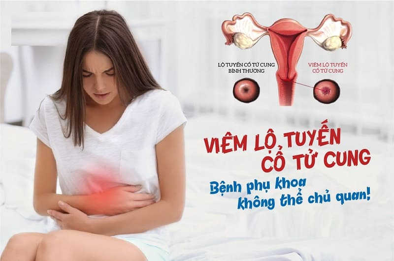 viêm lộ tuyến cổ tử cung độ 3 không thể coi thường