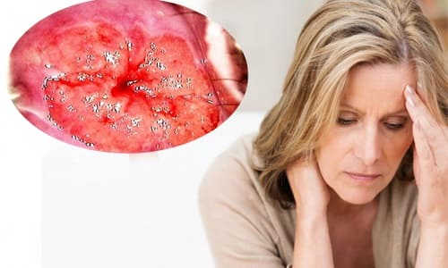 viêm lộ tuyến độ 1 là gì