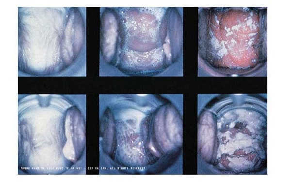 Nguyên nhân viêm lộ tuyến cổ tử cung 4