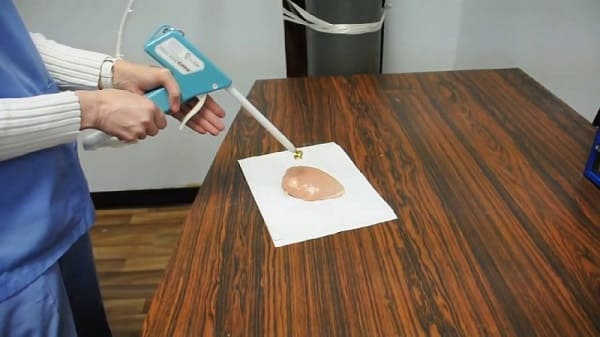 áp lạnh điều trị viêm lộ tuyến cổ tử cung