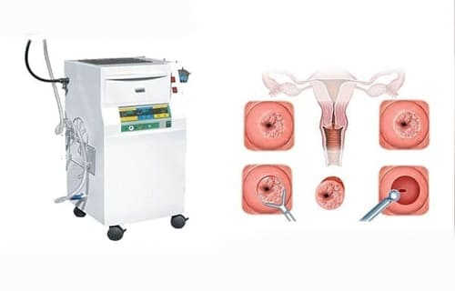 công nghệ dao leep điều trị viêm lộ tuyến cổ tử cung