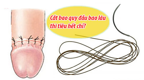 Cắt bao quy đầu bao lâu thì tiêu hết chỉ