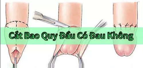 Cắt bao quy đầu có đau không