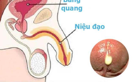 nhiễm trùng đường tiết niệu