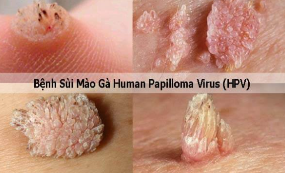 Sùi mào gà 152 xã đàn